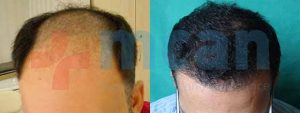 Vorher – nachher Haartransplantion | 4100 Grafts