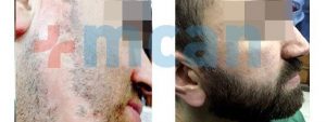 Antes y después trasplante de barba en Turquía