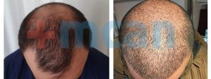 Antes y después trasplante capilar | 3.500 injertos – 10º día