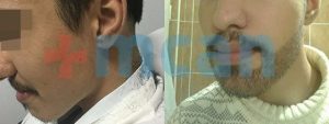 Antes y después del trasplante de barba