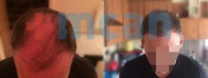 Antes y después del trasplante capilar – después de 6 meses. 3.500 injertos.