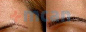 Antes y después del trasplante de cejas