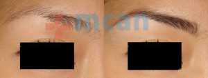 Antes y después del trasplante de cejas