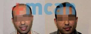 Antes y después del trasplante capilar en Turquía