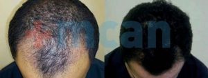 Antes y después del trasplante capilar en Turquía