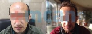 Antes y después del trasplante capilar en Turquía