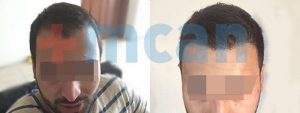 Antes y después del trasplante capilar en Turquía