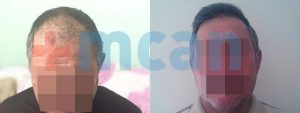 Antes y después del trasplante capilar en Turquía