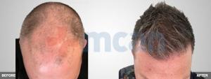 Haartransplant 3600 Grafts Nach dem 6 Monaten