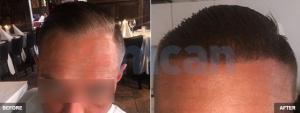 Haartransplant
