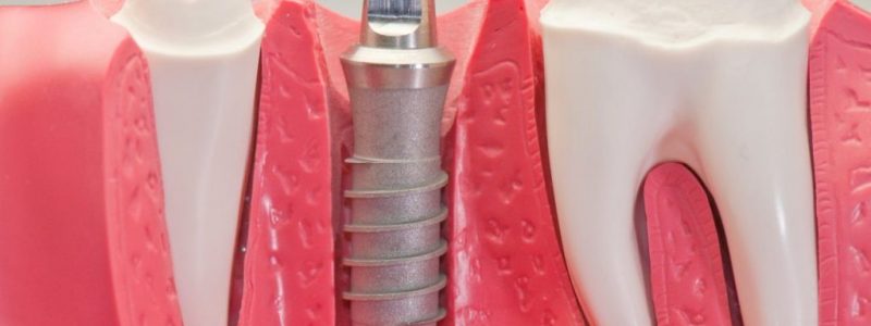 Zahnimplantate Türkei | MCAN Health Mcan Health Zahnimplantate Türkei