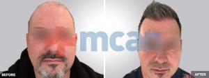 Haartransplant 3600 Grafts Nach dem 6 Monaten