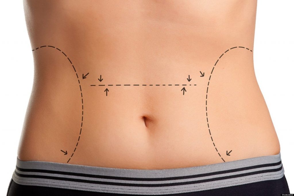 Bauchstraffung in der Tüerkei | Abdominoplastik | MCAN Health