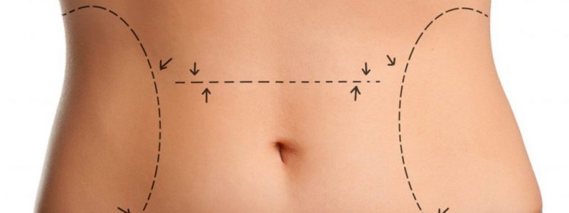 Tummy Tuck In Turkey | MCAN Health Tummy Tuck In Turkey | MCAN Health