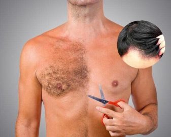 Body Hair Transplant | MCAN Health Blog Body Hair Transplant | MCAN Health Blog