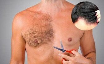 Body Hair Transplant | MCAN Health Blog Body Hair Transplant | MCAN Health Blog
