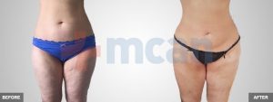 Liposuction Before-After
