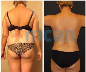 Liposuction Before-After