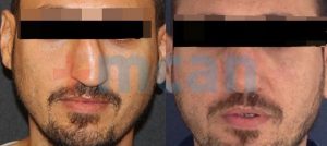 Nose Surgery