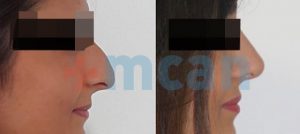 Before-After Affordable Rhinoplasty In Turkey | Nose Job in Turkey | MCAN Health Before-After