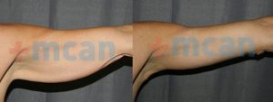 Arm Lift