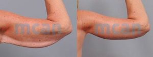 Arm Lift