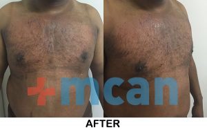 Gynecomastia – After