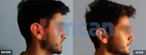 Nose Surgery