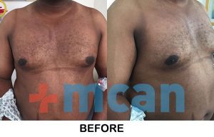 Gynecomastia – Before