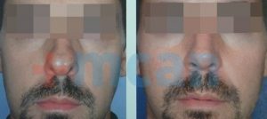 Before-After Affordable Rhinoplasty In Turkey | Nose Job in Turkey | MCAN Health Before-After