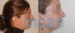 Before-After Affordable Rhinoplasty In Turkey | Nose Job in Turkey | MCAN Health Before-After