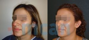 Before-After Affordable Rhinoplasty In Turkey | Nose Job in Turkey | MCAN Health Before-After