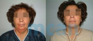 Neck Liposuction | Nick lift Before-After