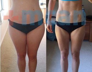 Liposuction Before-After
