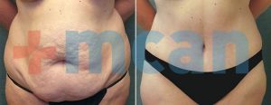 Before-After Tummy Tuck