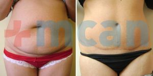 Before-After Tummy Tuck Turkey