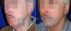 Antes y después del lifting de cuello