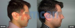 Before-After Affordable Rhinoplasty In Turkey | Nose Job in Turkey | MCAN Health Before-After