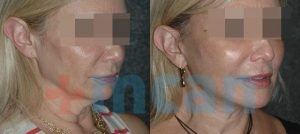 Antes y después del lifting de cuello
