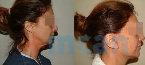 Neck lift