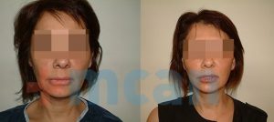Antes y después del mini lifting facial