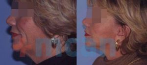 Antes y después del lifting facial