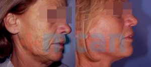 Antes y después del lifting facial