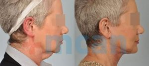 Antes y después del lifting de cuello
