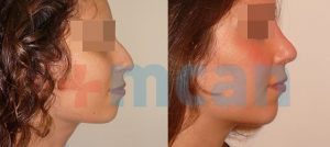 Before-After Affordable Rhinoplasty In Turkey | Nose Job in Turkey | MCAN Health Before-After