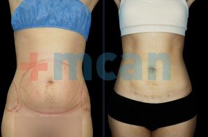 Vaser Liposuction Before-After