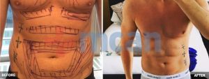 Vaser Liposuction Before-After