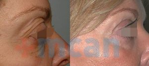 Eyelid Surgery