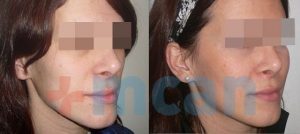 Cheek Augmentation with Fat Injection