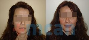 Cheek Augmentation with Fat Injection